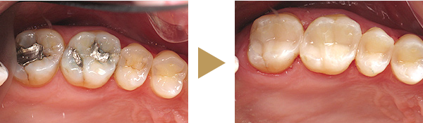 keramikinlays Zähne vor der Füllung und nach der Füllung