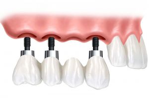 Implantologie-implantat Implantat-Zahnersatz