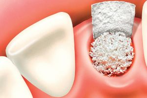 Knochenaufbau-verfahren-1 Abbildung Knochenaufbau Verfahren