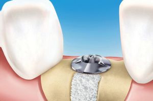 Knochenaufbau-verfahren-2 Abbildung des Knochenaufbauverfahrens