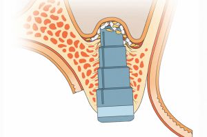 Knochenaufbau-verfahren Knochenaufbauverfahren