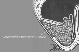 Knochenaufbau-SinusliftGranulat Knochenaufbauverfahren mit Sinuslift