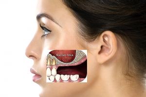 SinusliftKiefer-knochenaufbau