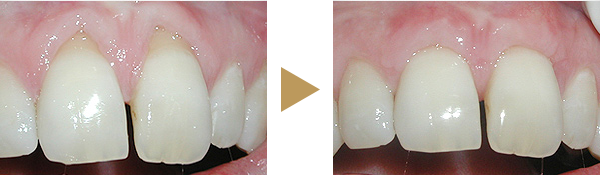 Zähne vor der Behandlung und nach der Behandlung mit Weichgewebe