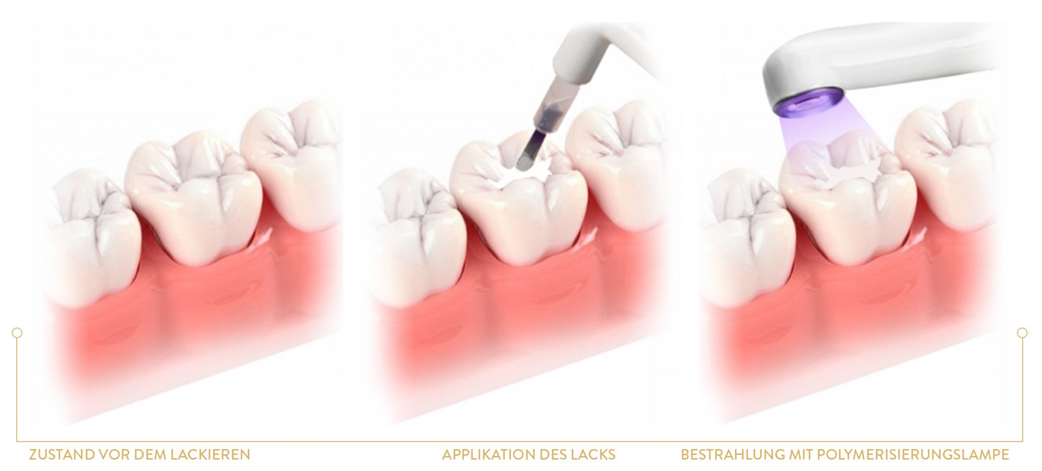LAKOWANIE-ZĘBÓW-de