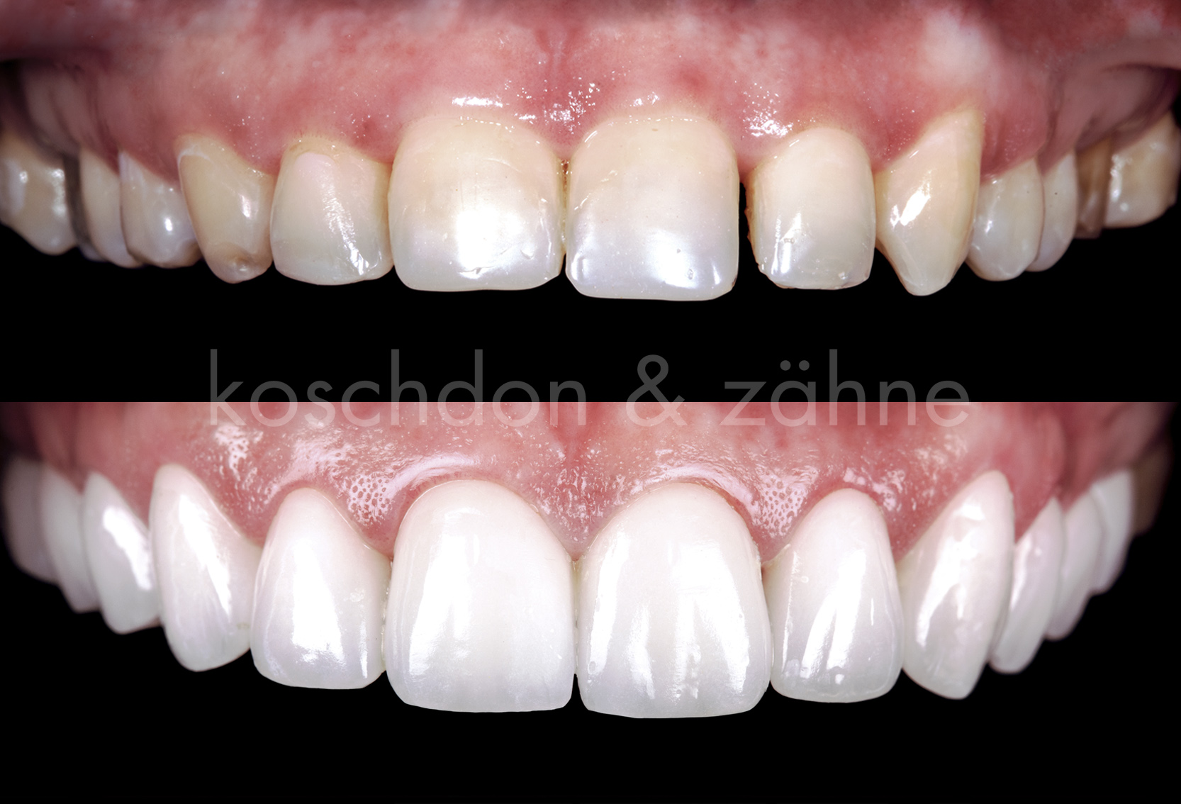 Perfect smile before and after bleaching procedure whitening of