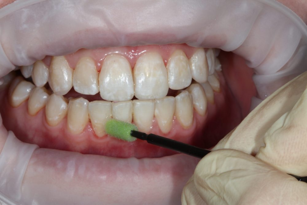 Glattflächenversiegelung