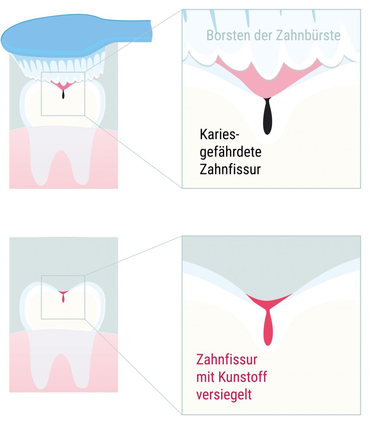 Fissurenversiegelung der Backenzähne