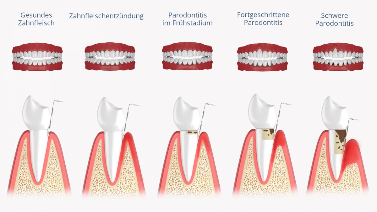 Parodontitis Symptome